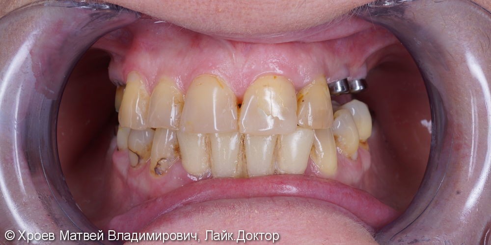 Тотальная реабилитация зубочелюстной системы: до и после - фото №1