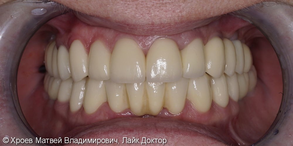 Тотальная реабилитация зубочелюстной системы: до и после - фото №2