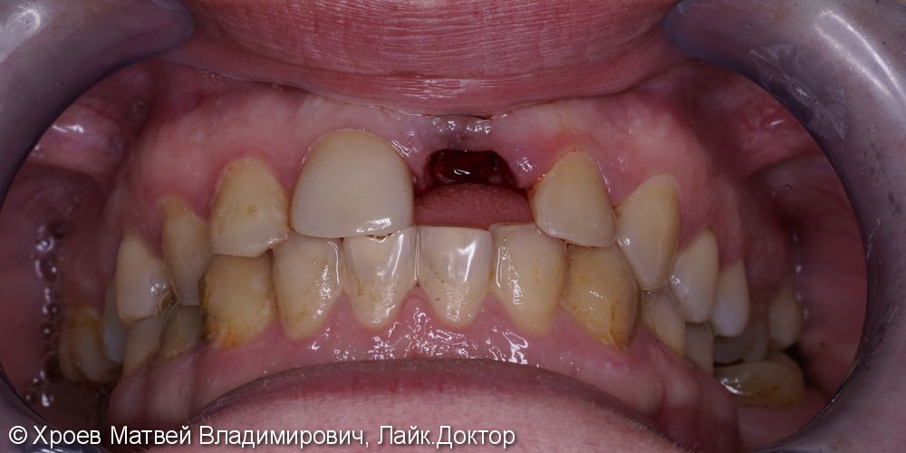 Удаление переднего зуба с одномоментной имплантацией, до и после - фото №1
