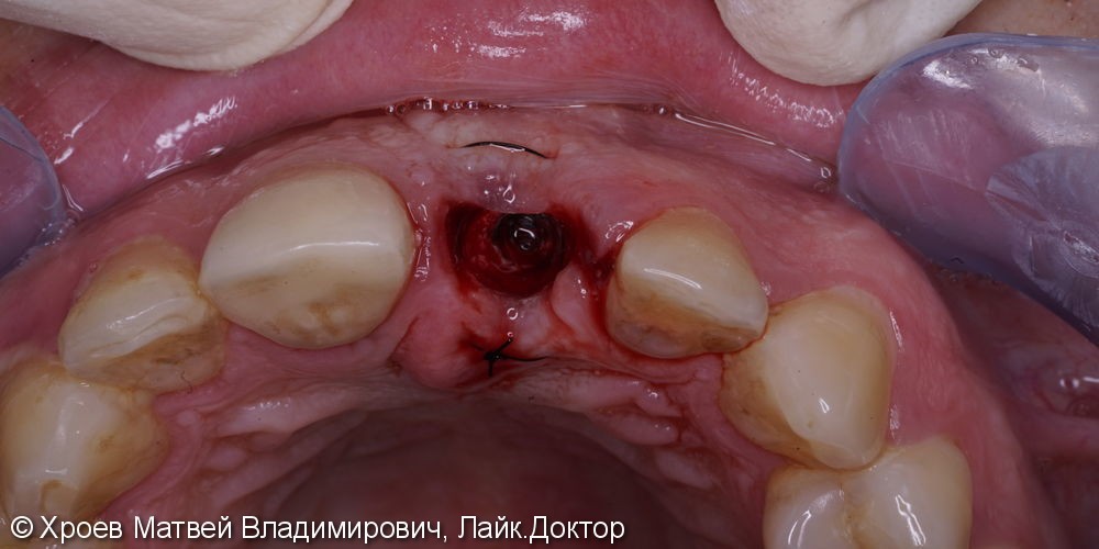 Удаление переднего зуба с одномоментной имплантацией, до и после - фото №2