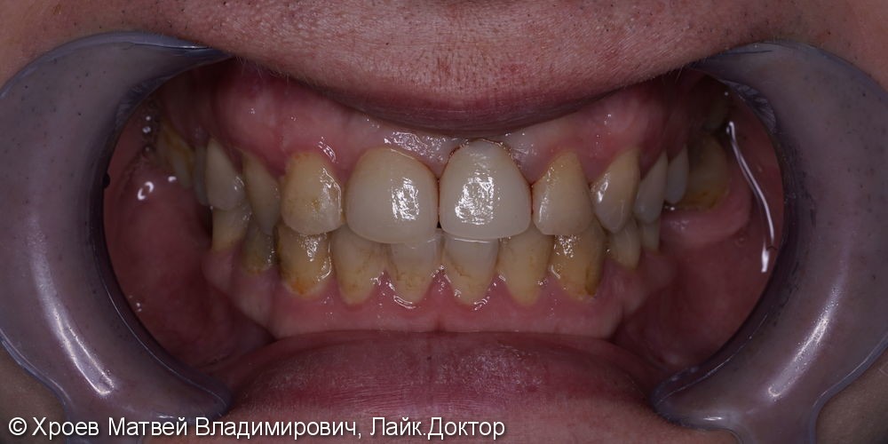 Удаление переднего зуба с одномоментной имплантацией, до и после - фото №5