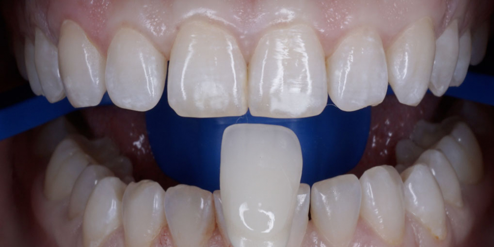 Результат профессионального отбеливания зубов системой ZOOM 4 - фото №1
