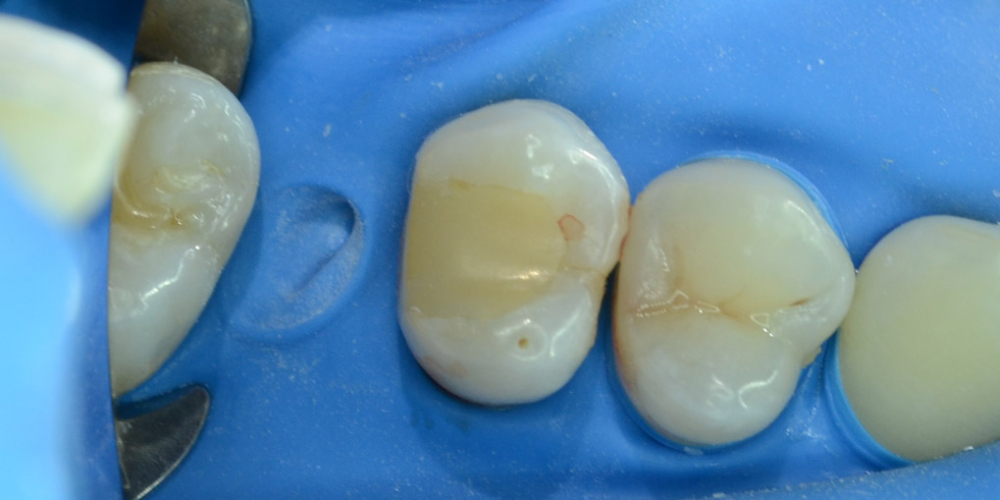 Художественная реставрация жевательного зуба материалом Charisma - фото №1