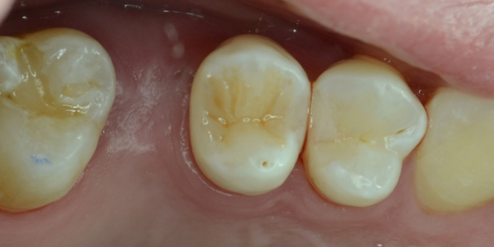 Художественная реставрация жевательного зуба материалом Charisma - фото №3