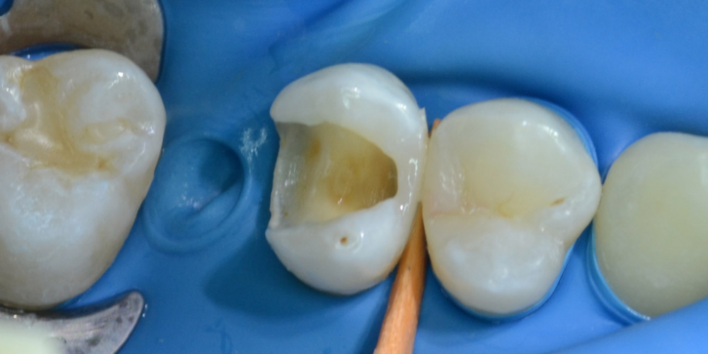 Художественная реставрация жевательного зуба материалом Charisma - фото №2