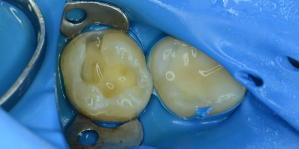 Лечение кариеса с последующей реставрацией анатомической формы зуба - фото №1