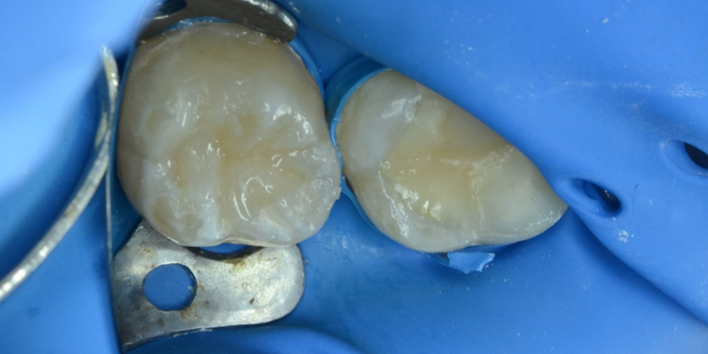 Лечение кариеса с последующей реставрацией анатомической формы зуба - фото №2