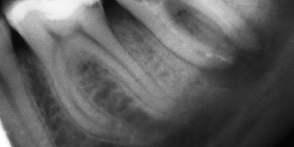 Пломбировка каналов гуттаперчей с последующей реставрацией коронки зуба - фото №1