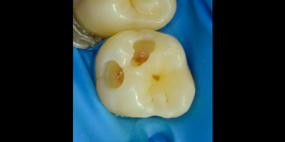 Лечение кариеса 26 зуба с использованием стоматологического микроскопа - фото №1