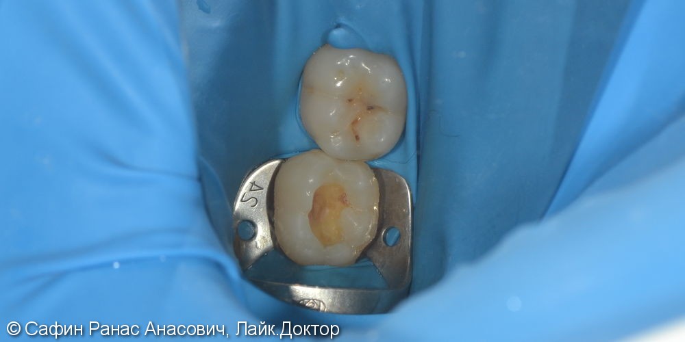Реставрация анатомической формы зуба - фото №1