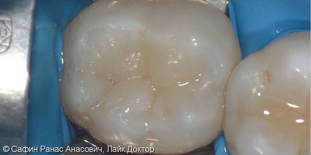Реставрация анатомической формы зуба - фото №2