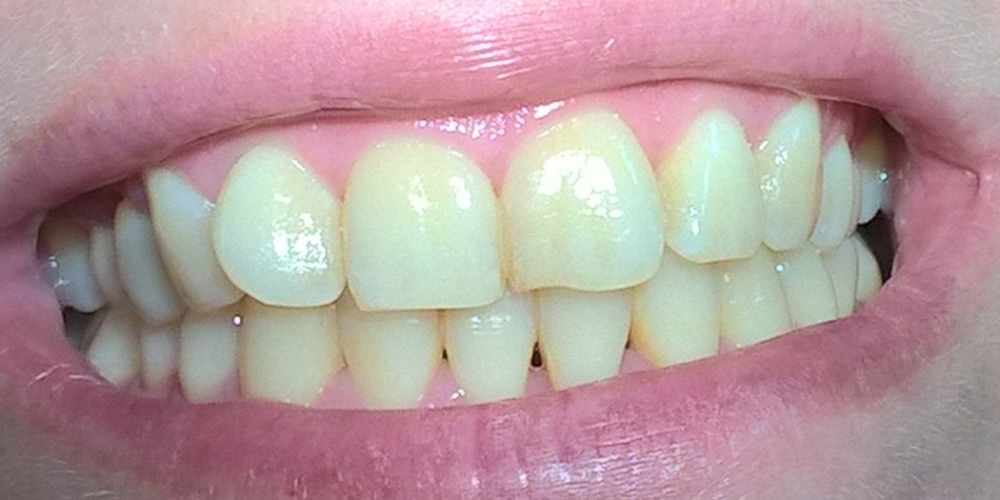 Результат отбеливания зубов по системе Amazing White - фото №1