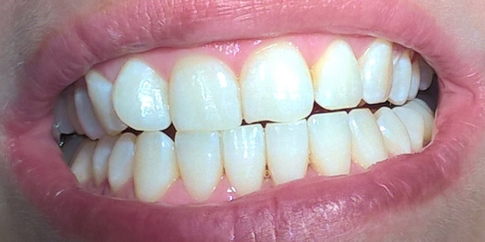 Результат отбеливания зубов по системе Amazing White - фото №2