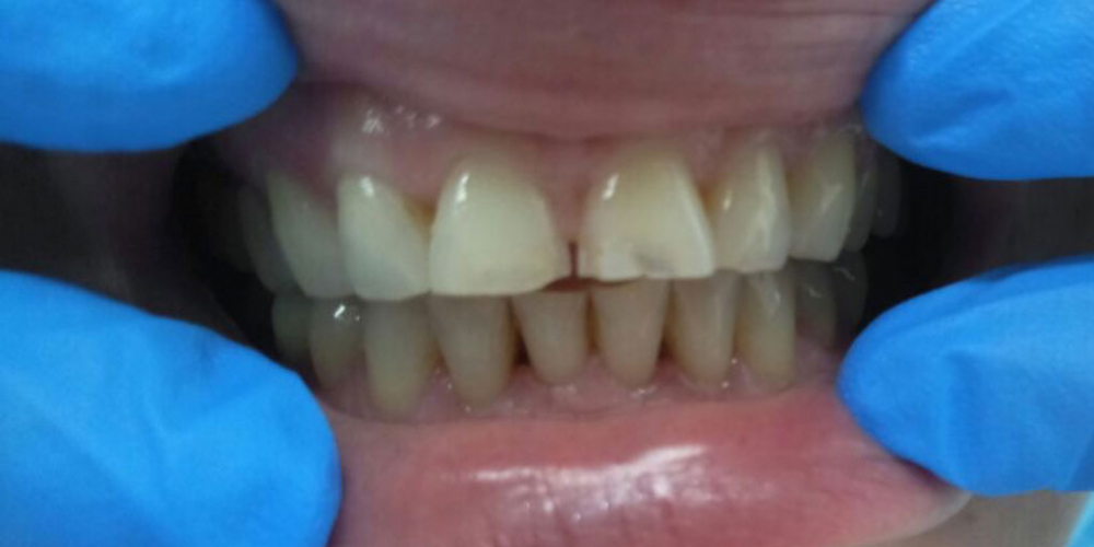 Результат реставрации центральных зубов - фото №1