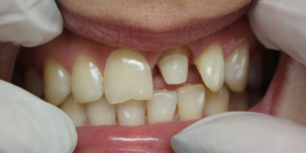 Восстановление центрального зуба  диоксид циркониевой коронкой - фото №1