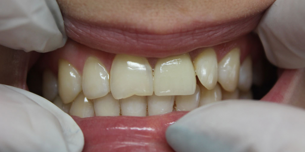 Восстановление центрального зуба  диоксид циркониевой коронкой - фото №2