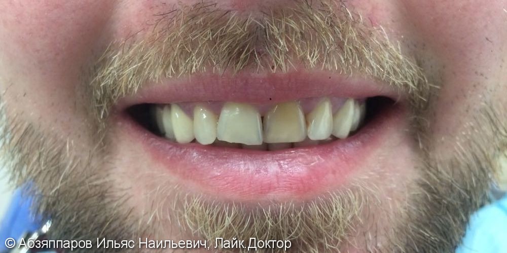 Результат эндоотбеливания переднего зуба, до и после - фото №1