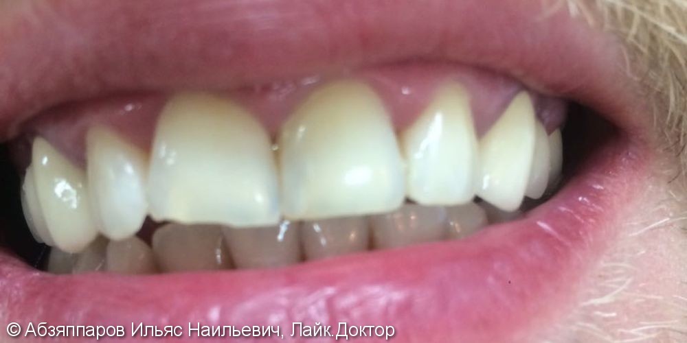 Результат эндоотбеливания переднего зуба, до и после - фото №2