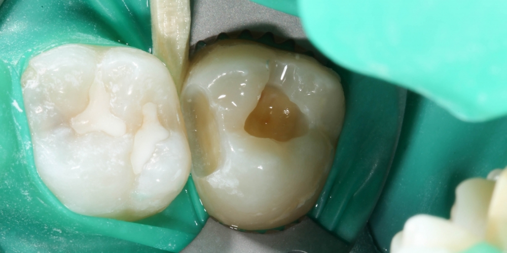 Лечение кариеса, реставрация зуба - фото №1