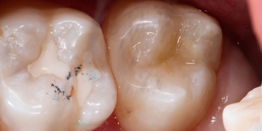 Лечение кариеса, реставрация зуба - фото №2