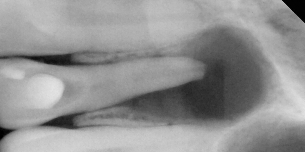 Жалобы на отек мягких тканей лица и боли при накусывании на зуб - фото №1