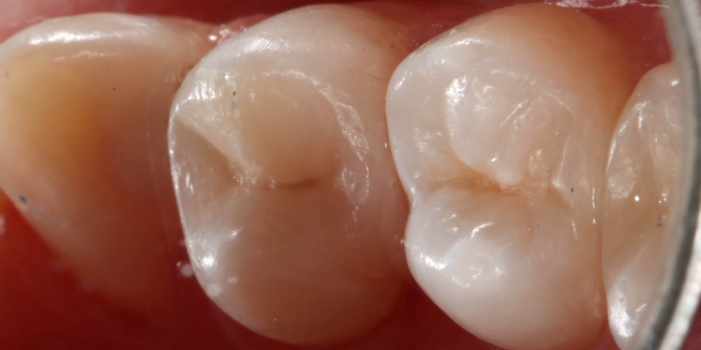 Кариозная полость на контактных поверхностях жевательного зуба - фото №2