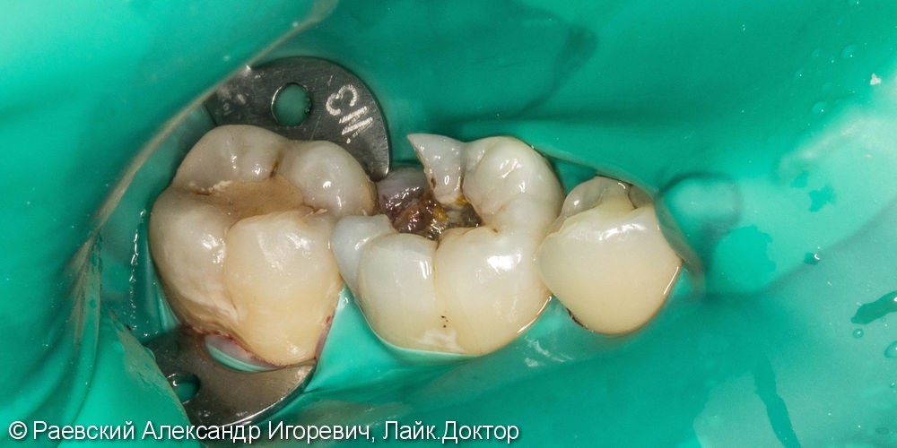 46 зуб анатомия каналов Мини-импланты Томск Радищева