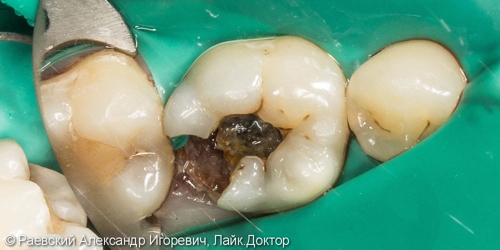 Лечение пульпита 46 зуба, 6 корневых каналов - фото №2