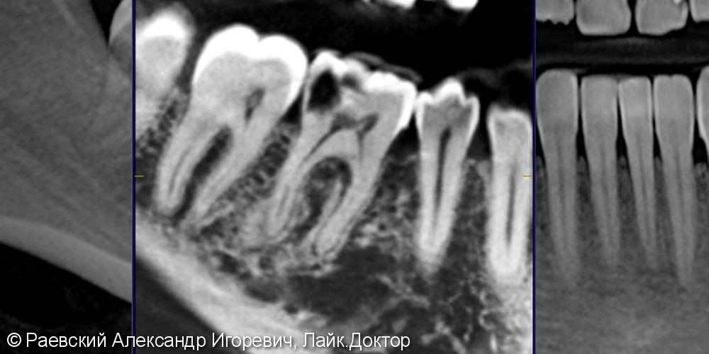 Лечение пульпита 46 зуба, 6 корневых каналов - фото №3