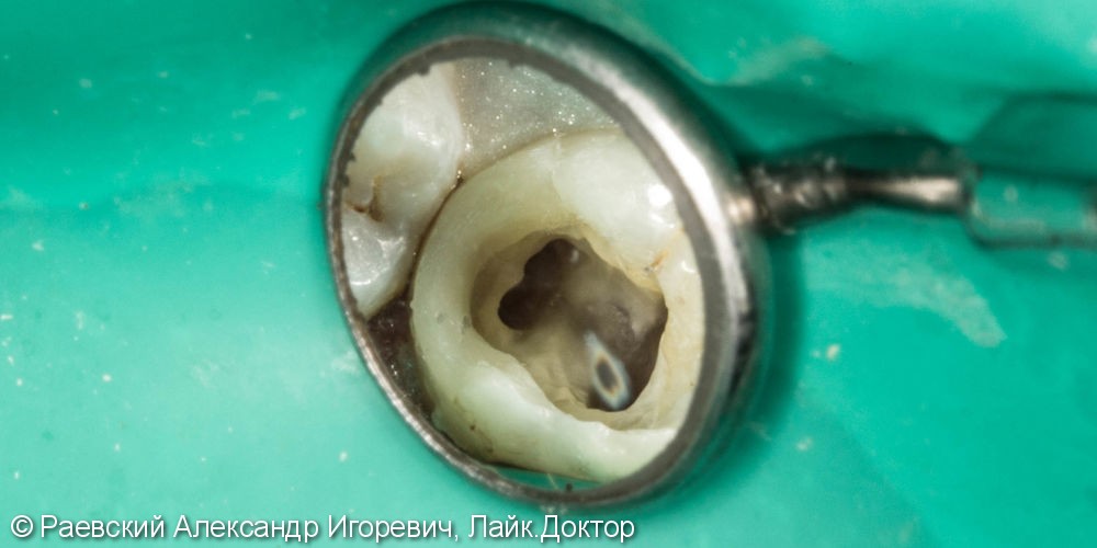 Лечение пульпита 46 зуба, 6 корневых каналов - фото №4