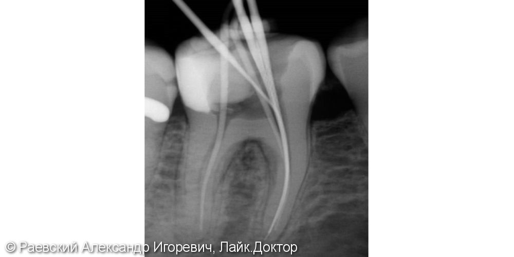 Лечение пульпита 46 зуба, 6 корневых каналов - фото №5