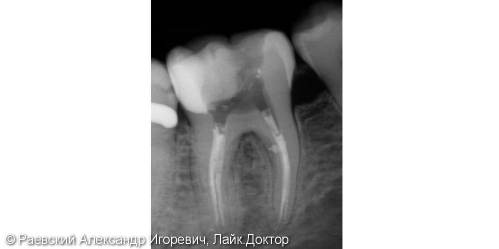 Лечение пульпита 46 зуба, 6 корневых каналов - фото №7