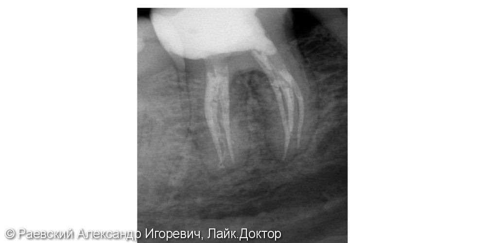 Лечение пульпита 46 зуба, 6 корневых каналов - фото №8