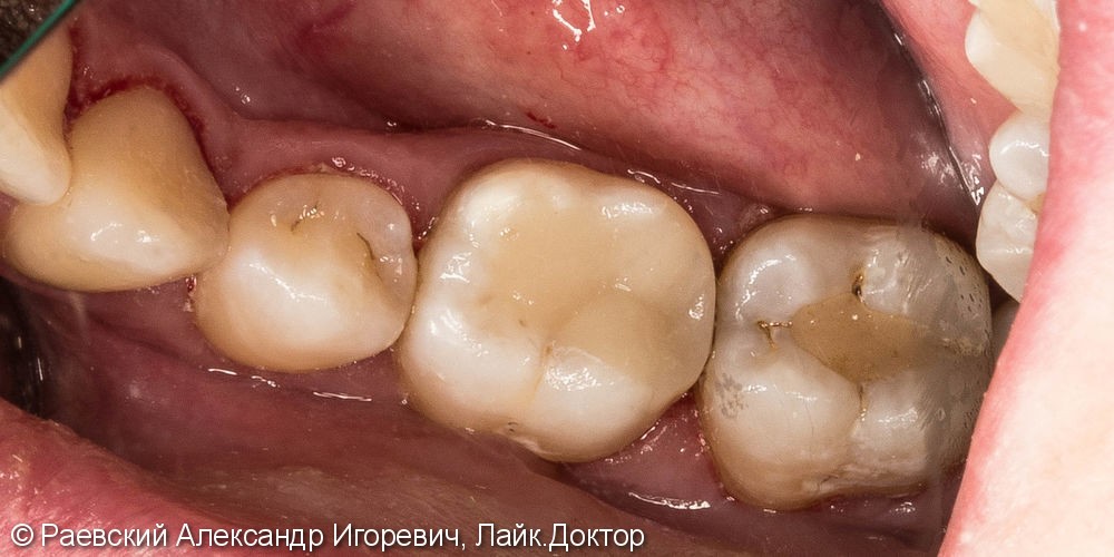 Лечение пульпита 46 зуба, 6 корневых каналов - фото №9