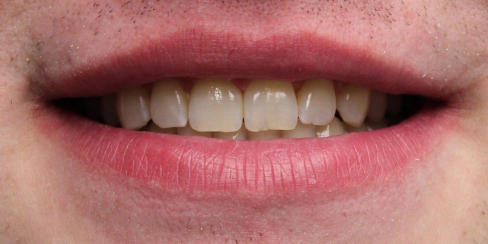 Отбеливание зубов в зоне широкой улыбки - фото №1