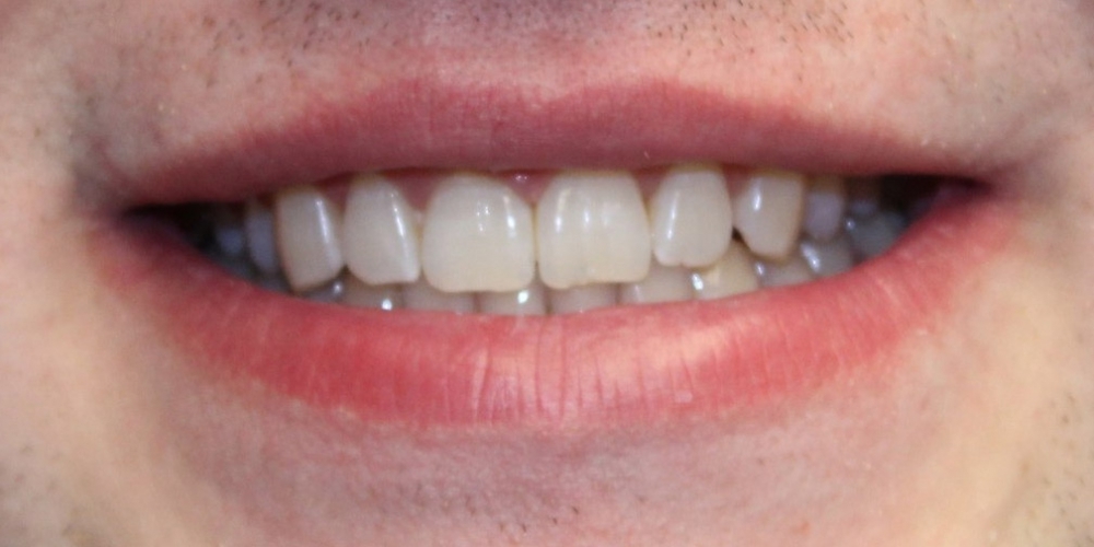 Отбеливание зубов в зоне широкой улыбки - фото №2