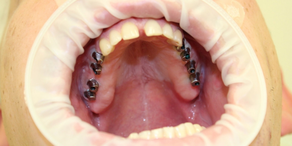 Имплантация и протезирование жевательных зубов верхней челюсти - фото №1