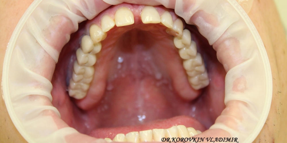 Имплантация и протезирование жевательных зубов верхней челюсти - фото №2