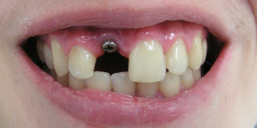 Имплантация и протезирование переднего зуба - фото №1