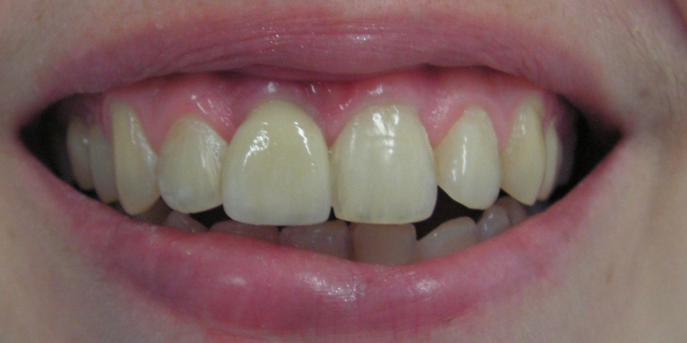 Имплантация и протезирование переднего зуба - фото №2
