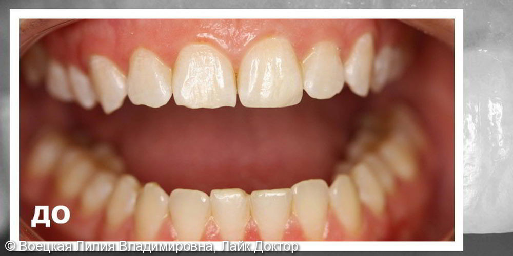Восстановление внешнего вида зубов, не прибегая к их обработке - фото №1