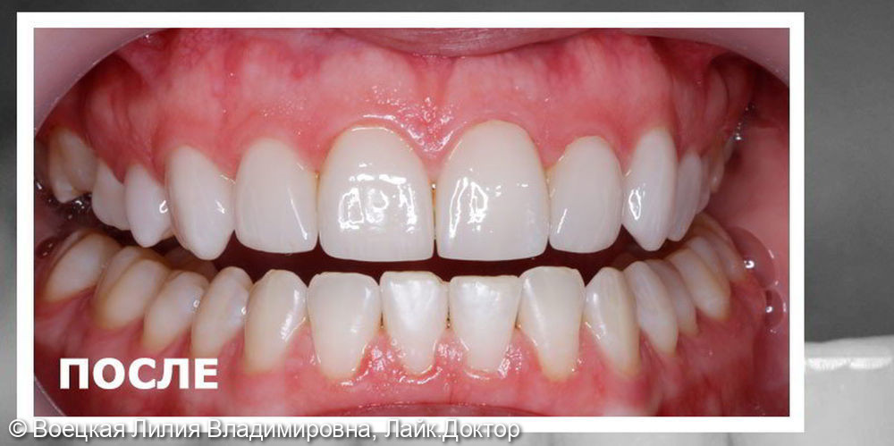 Восстановление внешнего вида зубов, не прибегая к их обработке - фото №2
