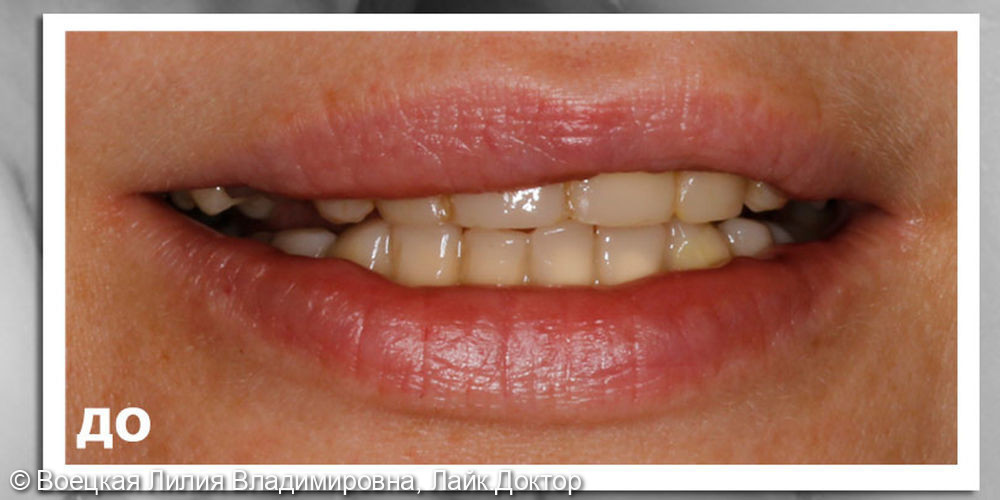 Ортодонтическое лечение, имплантация 2.6 и минимальная обработка зубов. Пресс керамика. Цвет А1 VITA - фото №1