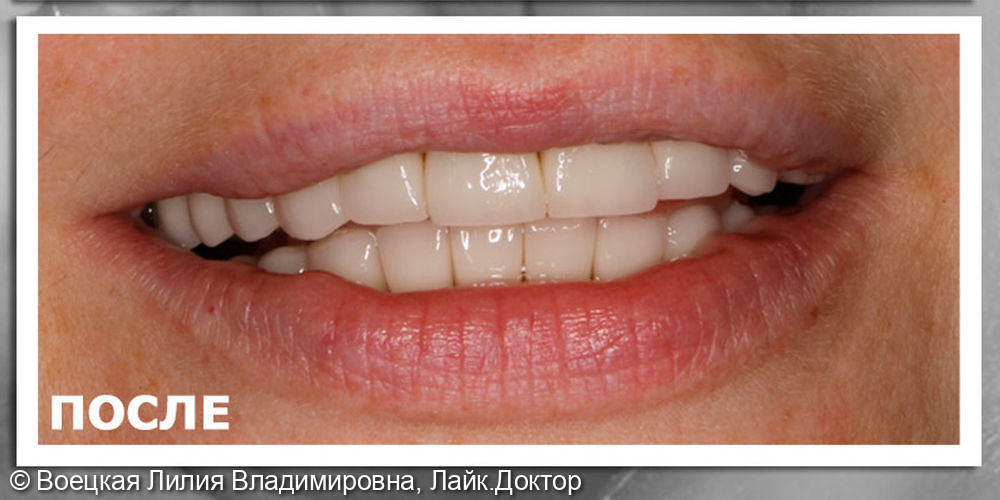 Ортодонтическое лечение, имплантация 2.6 и минимальная обработка зубов. Пресс керамика. Цвет А1 VITA - фото №2