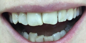 Реставрация 4х зубов верхней и нижней челюсти - фото №1
