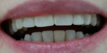 Реставрация 4х зубов верхней и нижней челюсти - фото №2