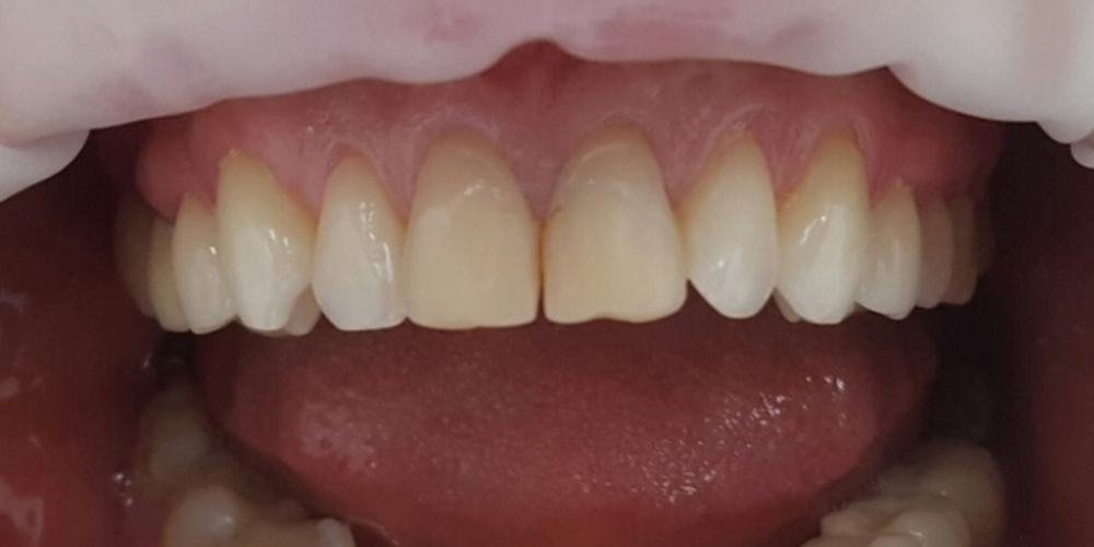 Реставрация двух передних зубов верхней челюсти современным композиционным материалом - фото №1