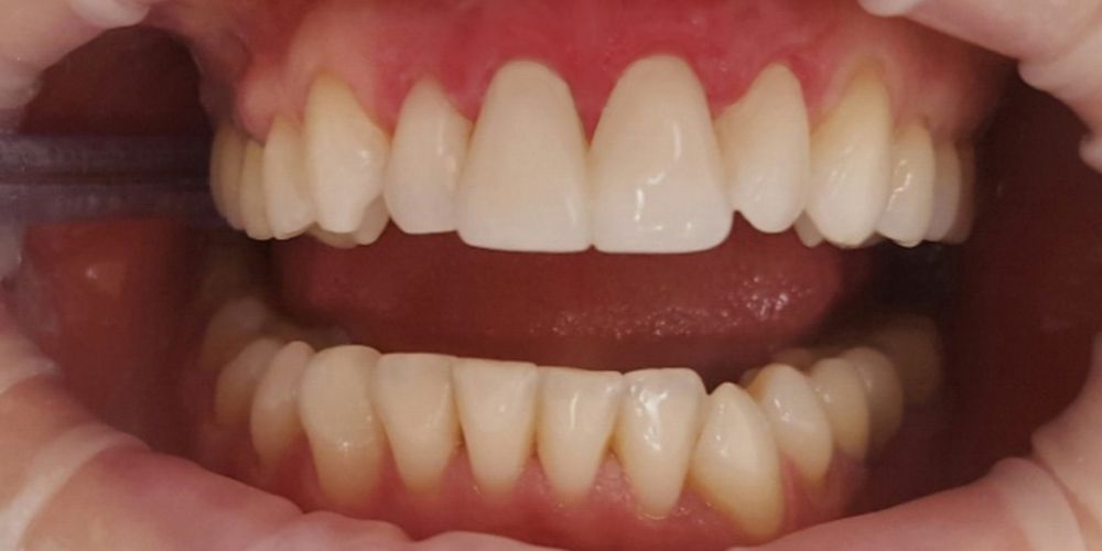 Реставрация двух передних зубов верхней челюсти современным композиционным материалом - фото №2