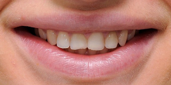 Установка шести виниров из керамики E-MAX на передние зубы - фото №1