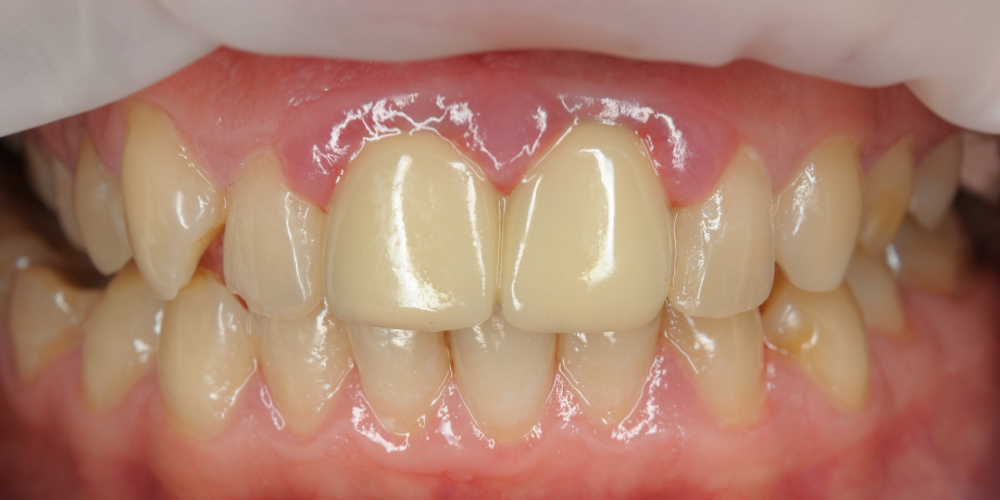 Протезирование двух центральных резцов цельнокерамическими коронками E.Max и отбеливание зубов - фото №1
